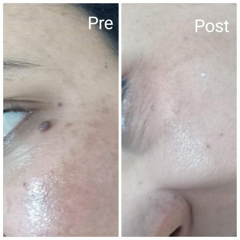 Skin tags removal from the eye area